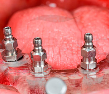 Implantología dental en Jaén